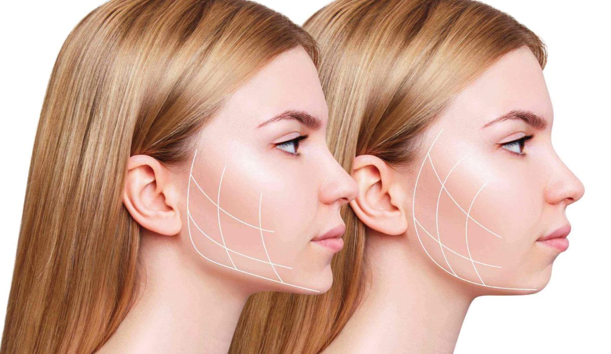jawline-dolgu jawline-dolgu
