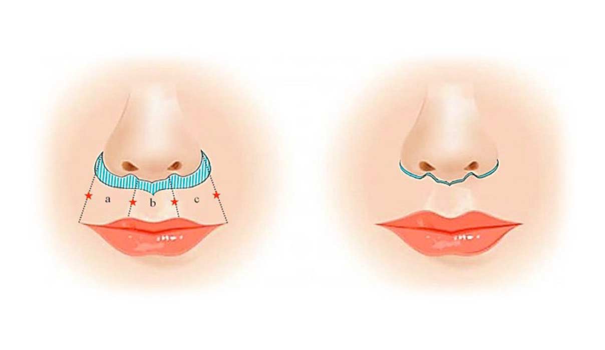 lip-lift lip-lift