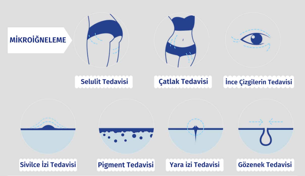 mikro-iğneleme- mikro-iğneleme-