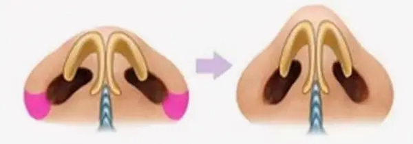 تجميل طرف الانف 15 تجميل طرف الانف