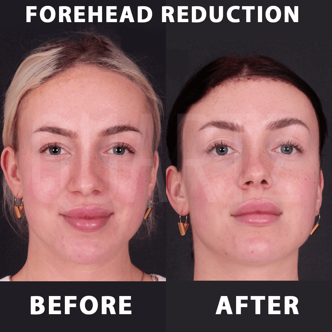 Alin Daraltma Kare Before After 3