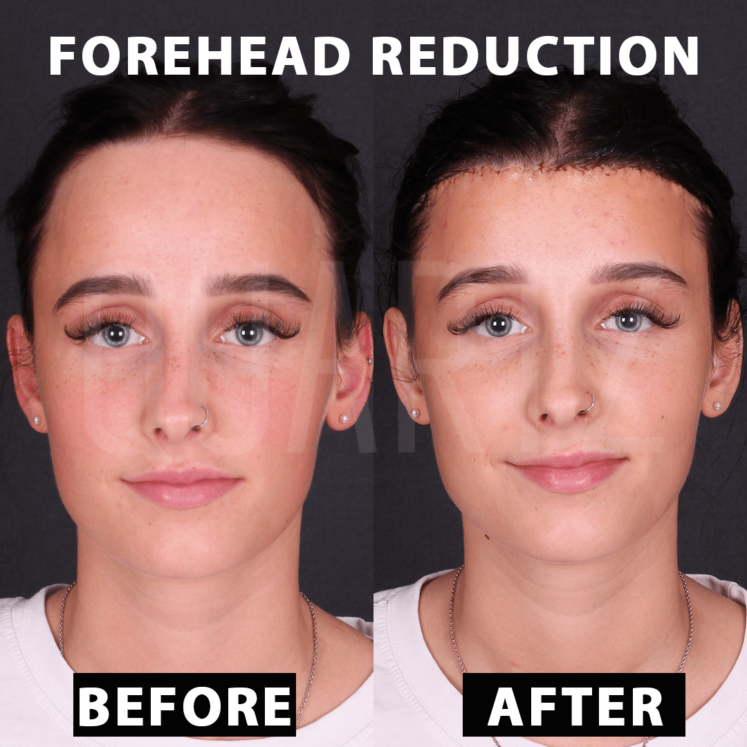 Alin Daraltma Kare Before After 4