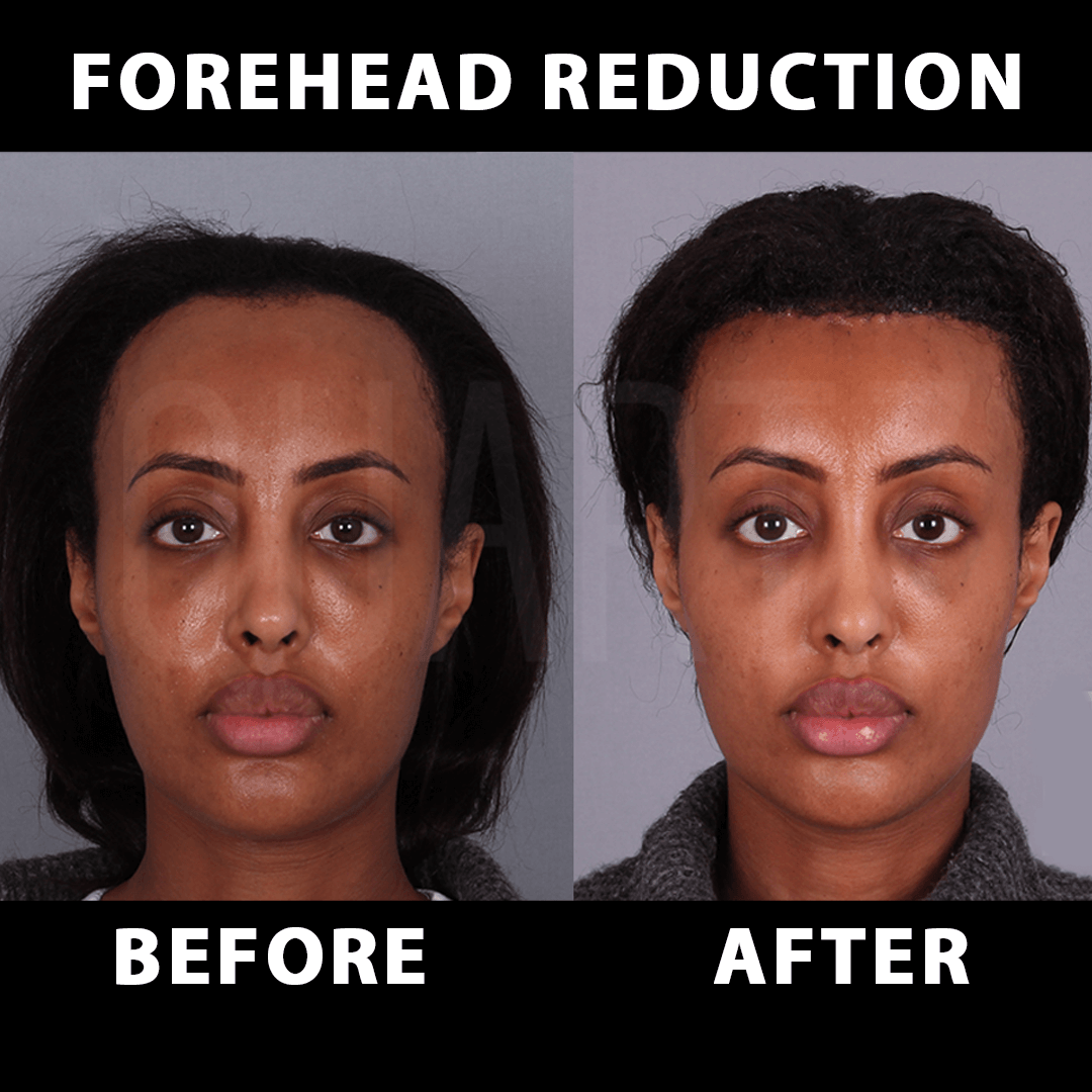 Alin Daraltma Kare Before After 8
