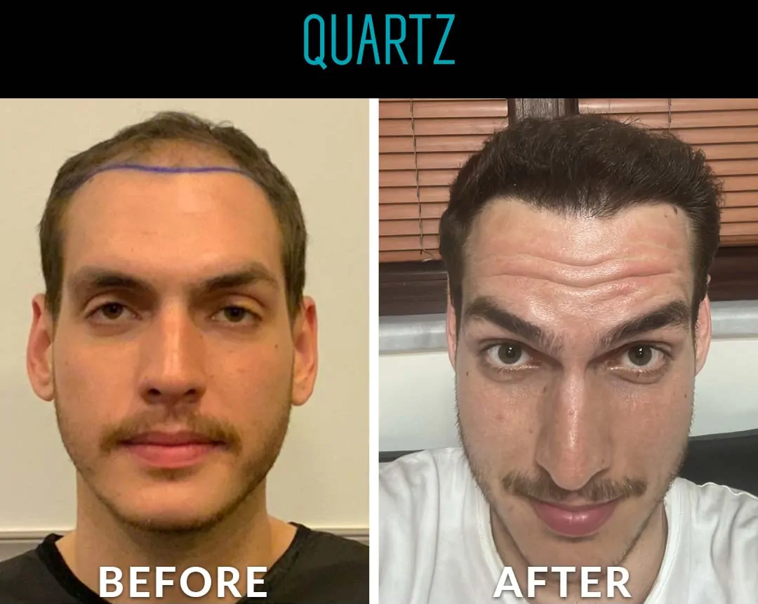 Sac Ekim Before After 14