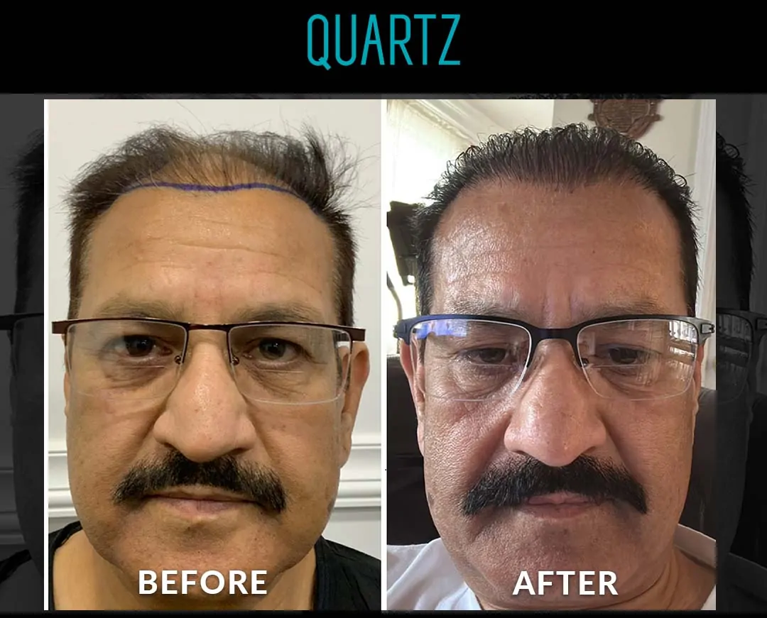 Sac Ekim Before After 2