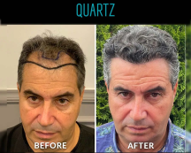 اعلان زراعة الشعر 11 Sac Ekim Before After 3