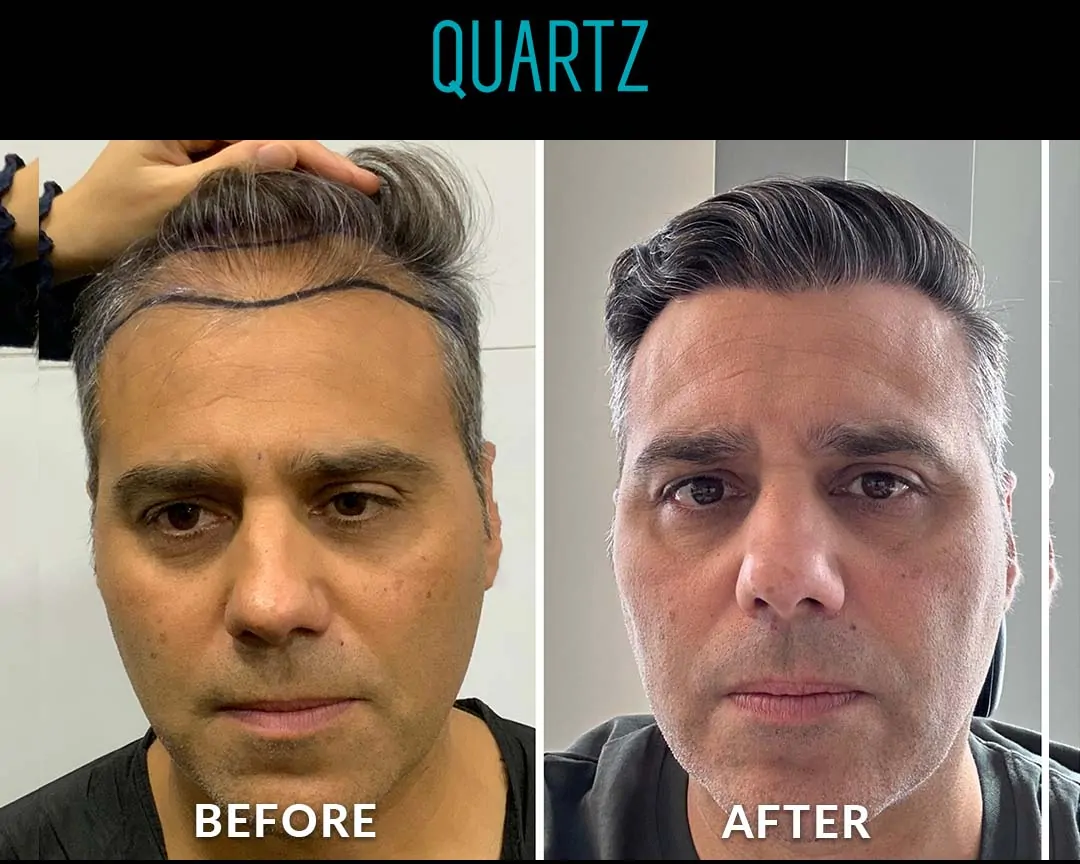 Sac Ekim Before After 4
