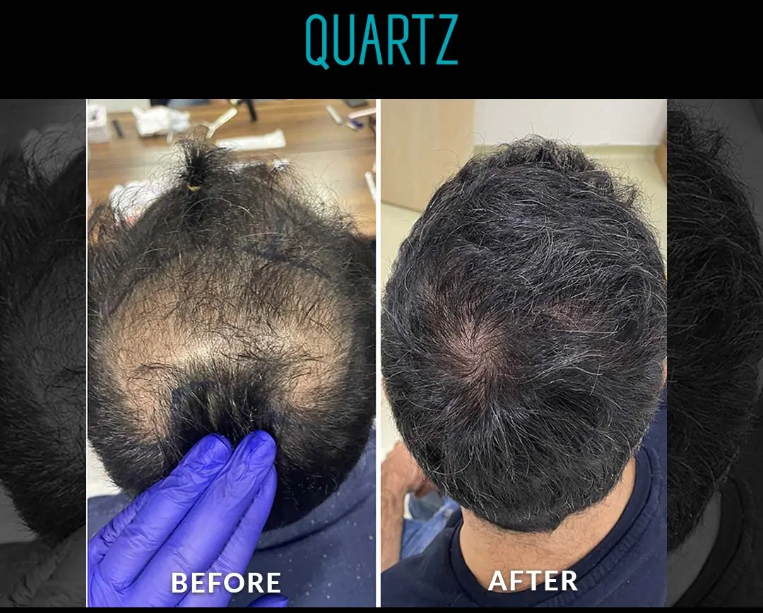 اعلان زراعة الشعر 13 Sac Ekim Before After 6