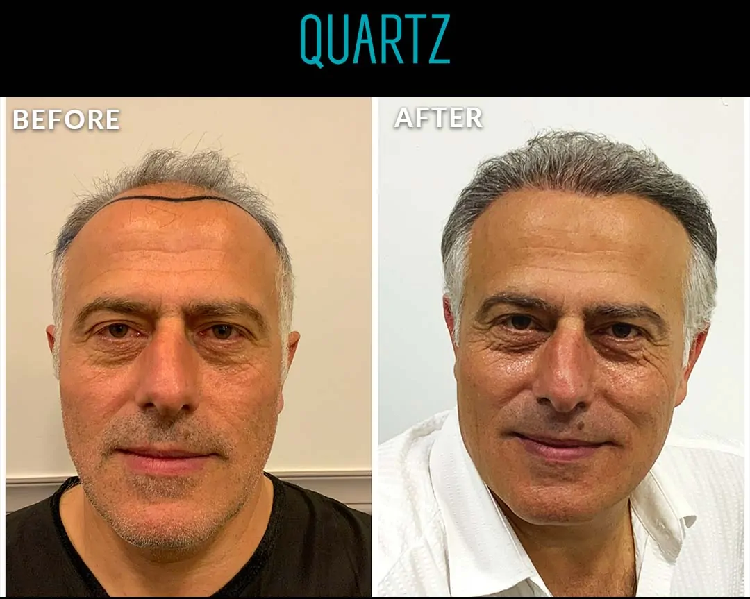 Sac Ekim Before After 9