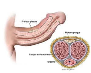 What is Peyronie’s Disease What is Peyronies Disease