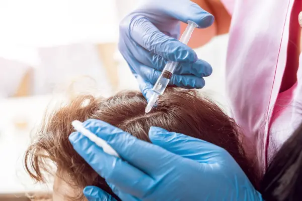 زراعة الشعر بالخلايا الجذعية