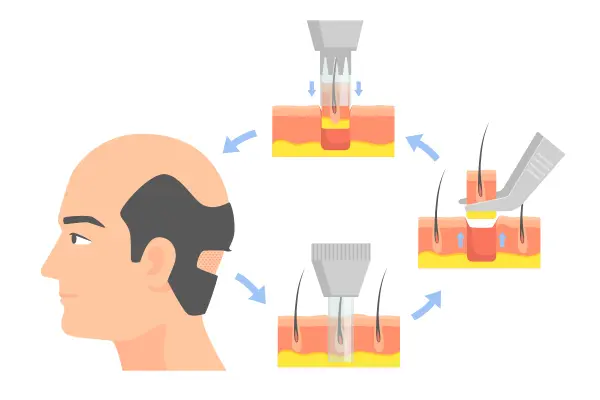زراعة الشعر بدون حلاقة