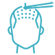 hair transplant cyan