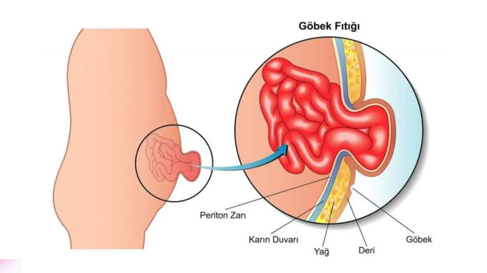 gobek-fitigi