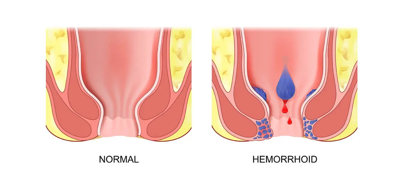 hemoroid tedavisi 1