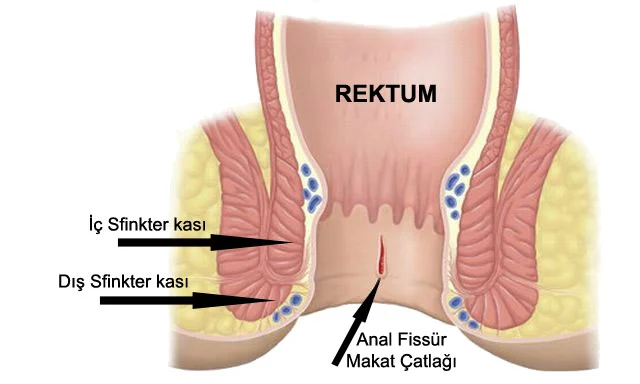 Anal Fissür Tedavisi Anal Fissür Tedavisi