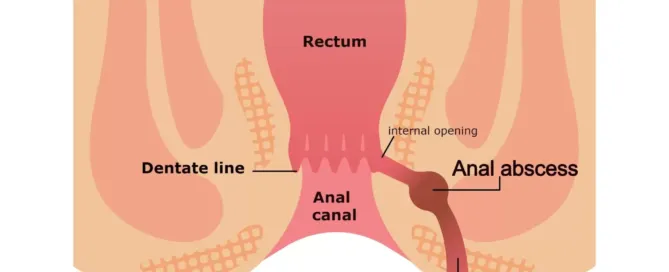 Anal Fistul tedavisi