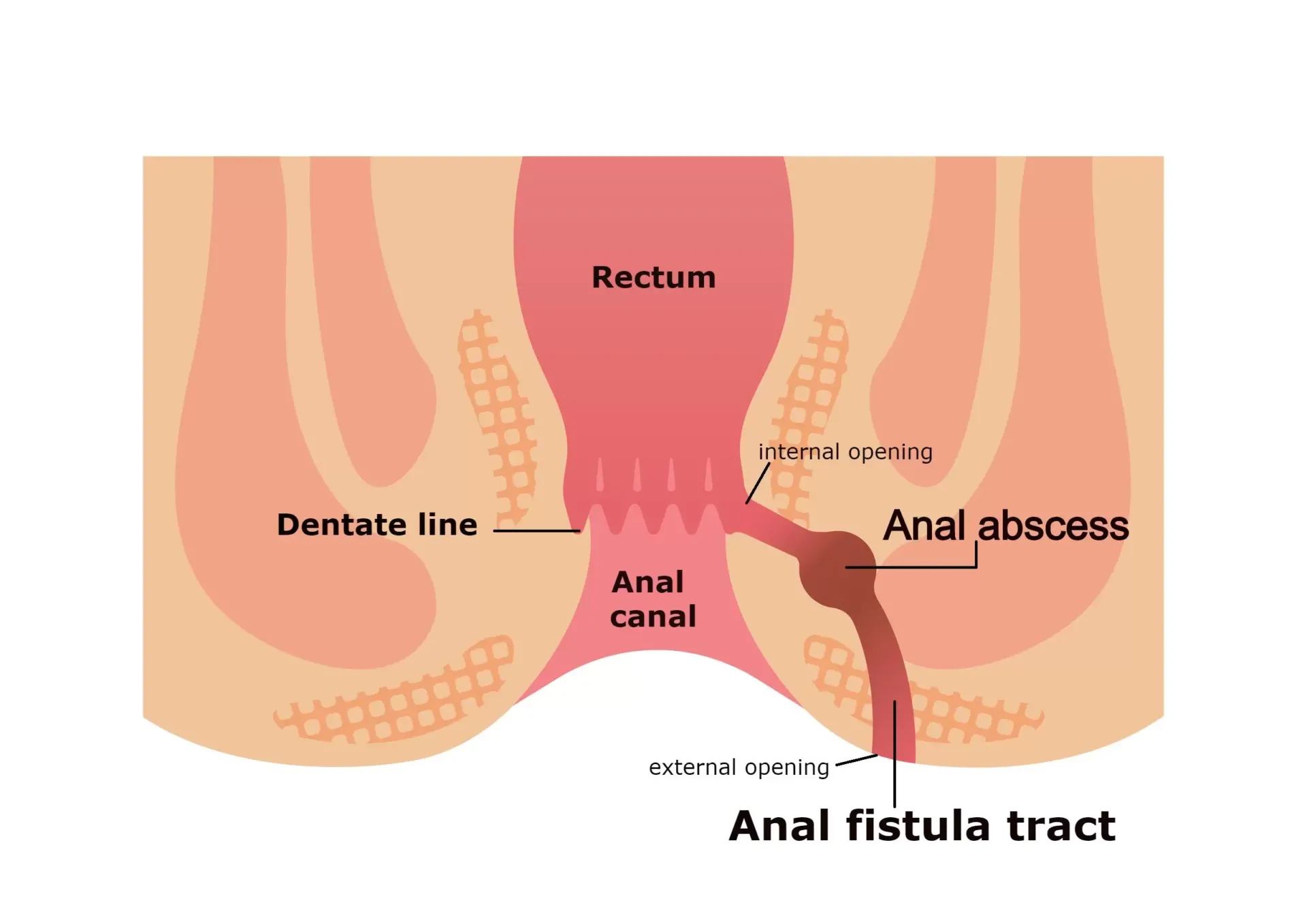 Anal Fistül tedavisi Anal Fistul tedavisi