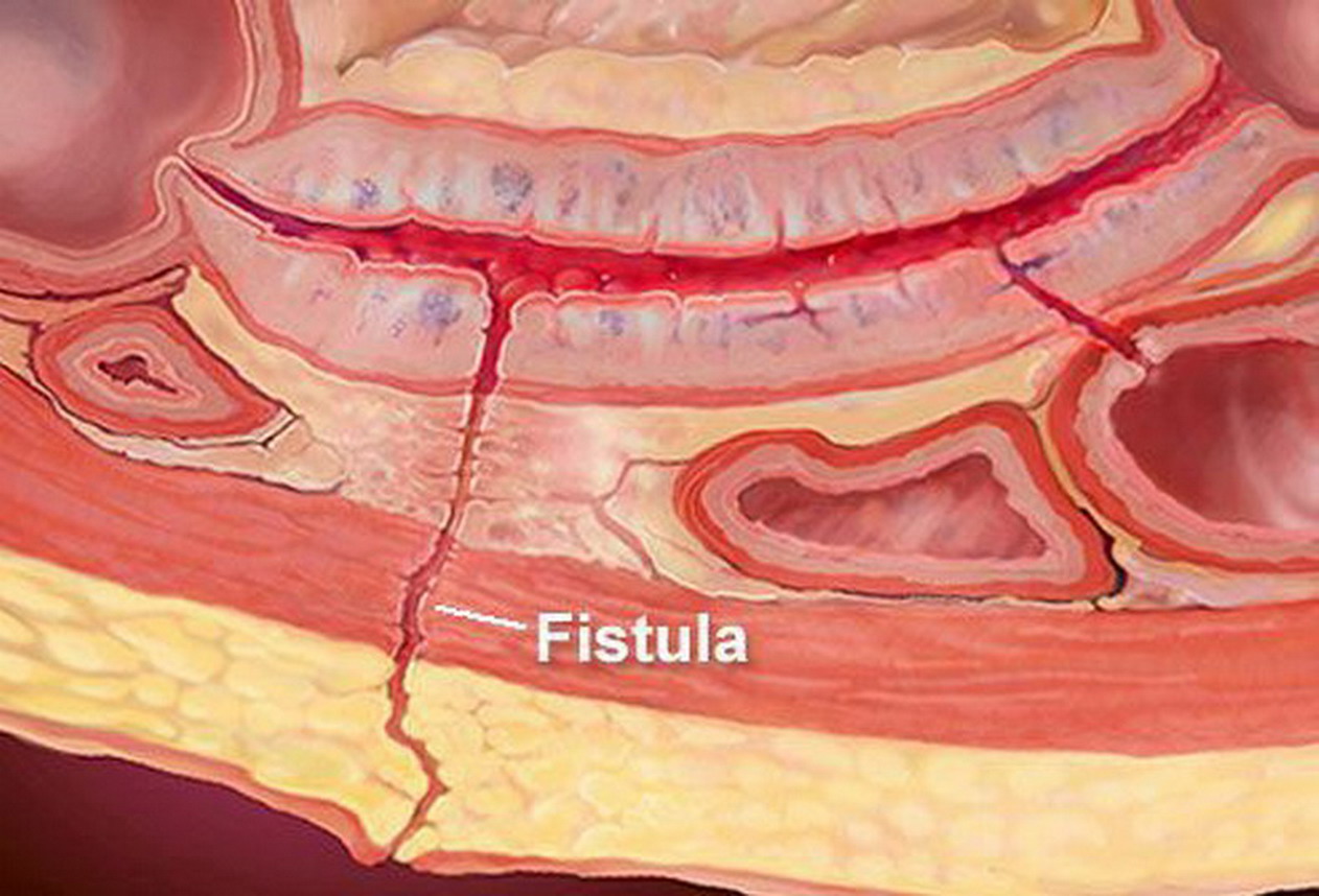 Anal Fistül Anal Fistül