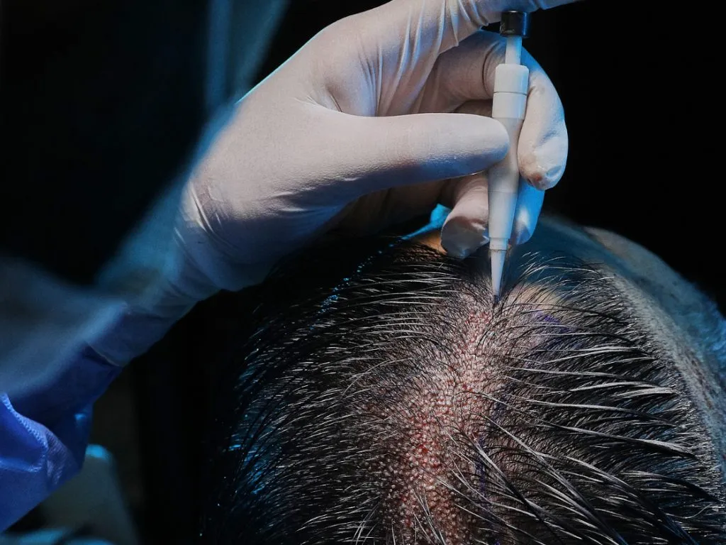 dhi hair transplant