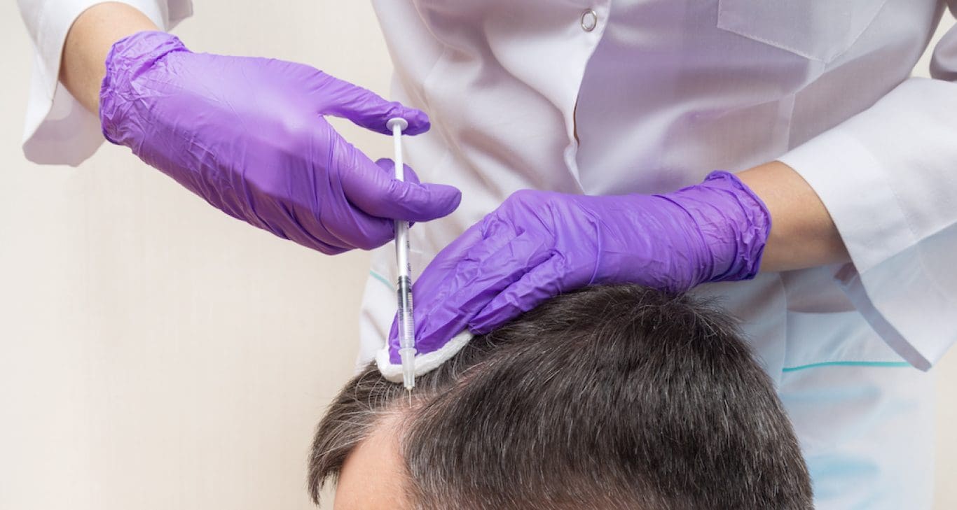 exosome hair transplant