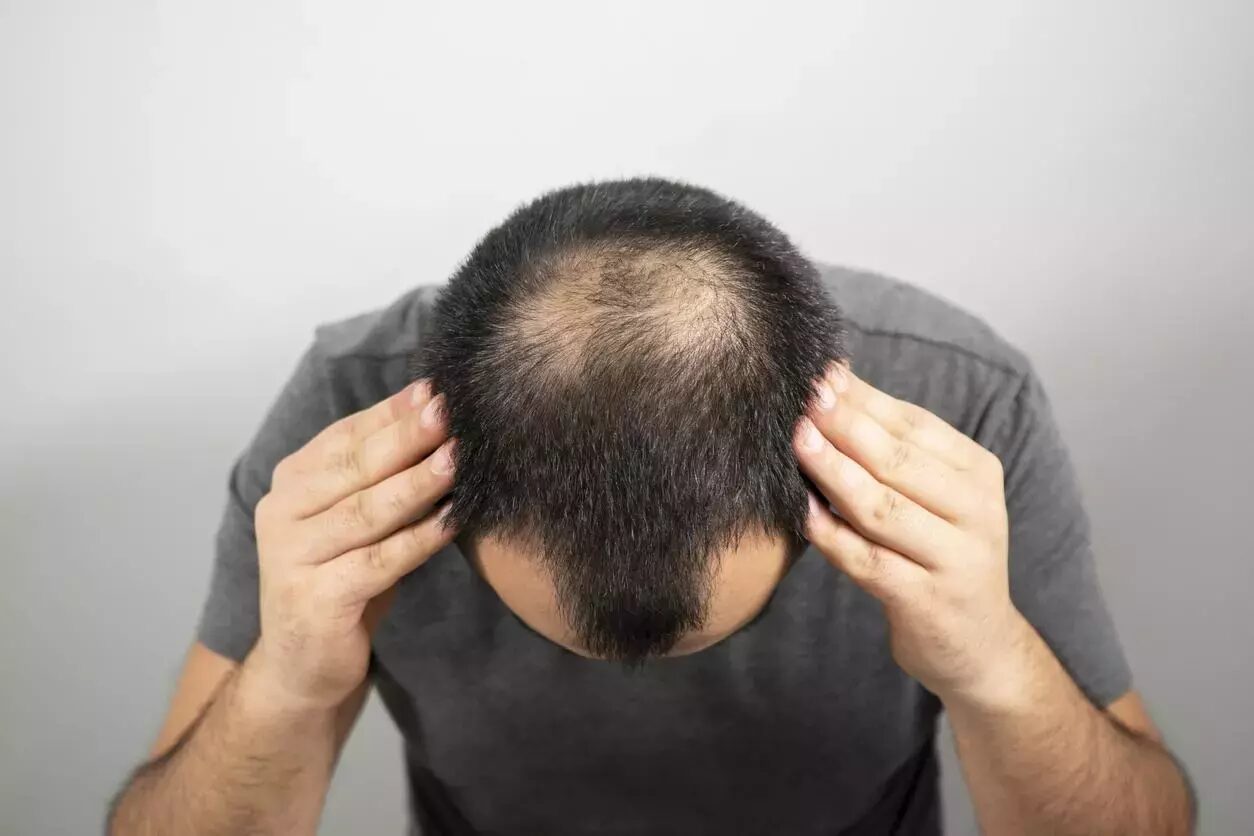 Haarausfall-durch-Stress Haarausfall durch Stress