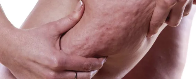 lipodem
