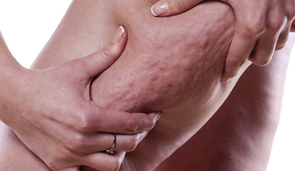 lipodem