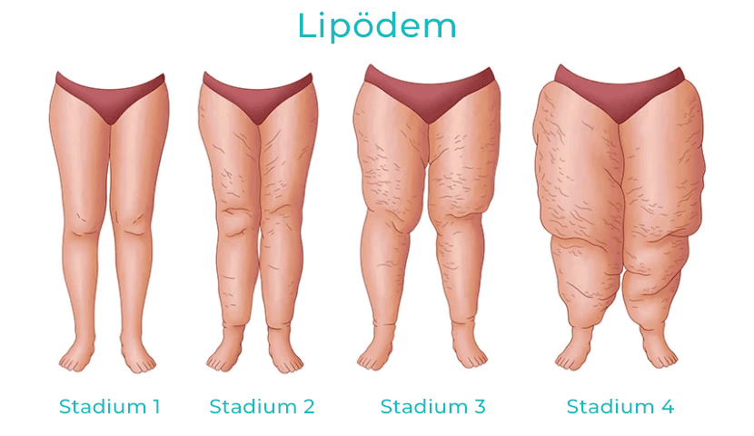 lipödem