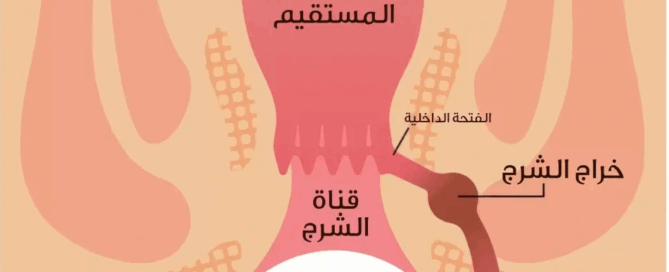 الناسور الشرجي