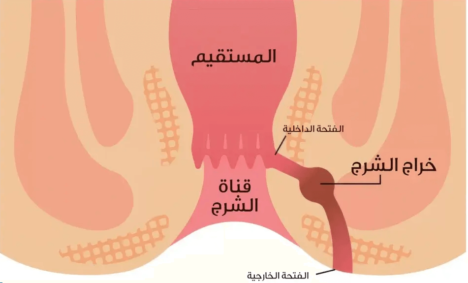 الناسور الشرجي