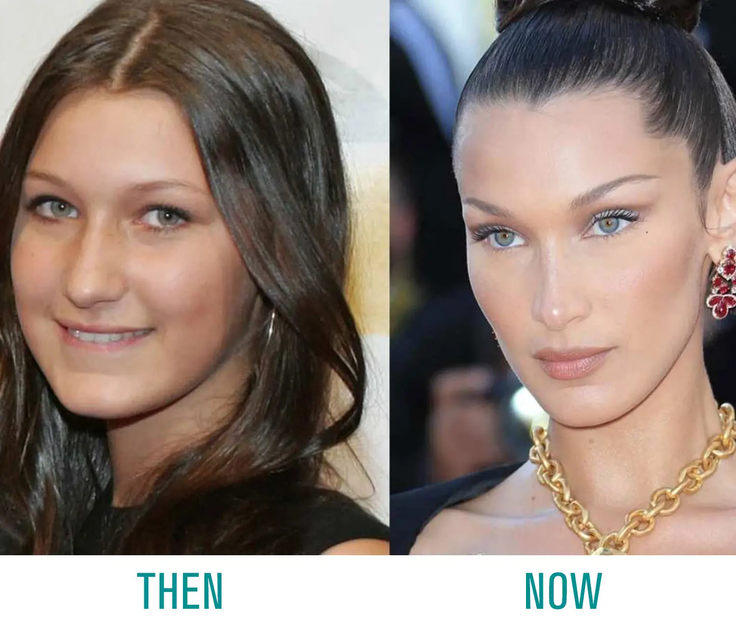 Bella Hadid Nose Job