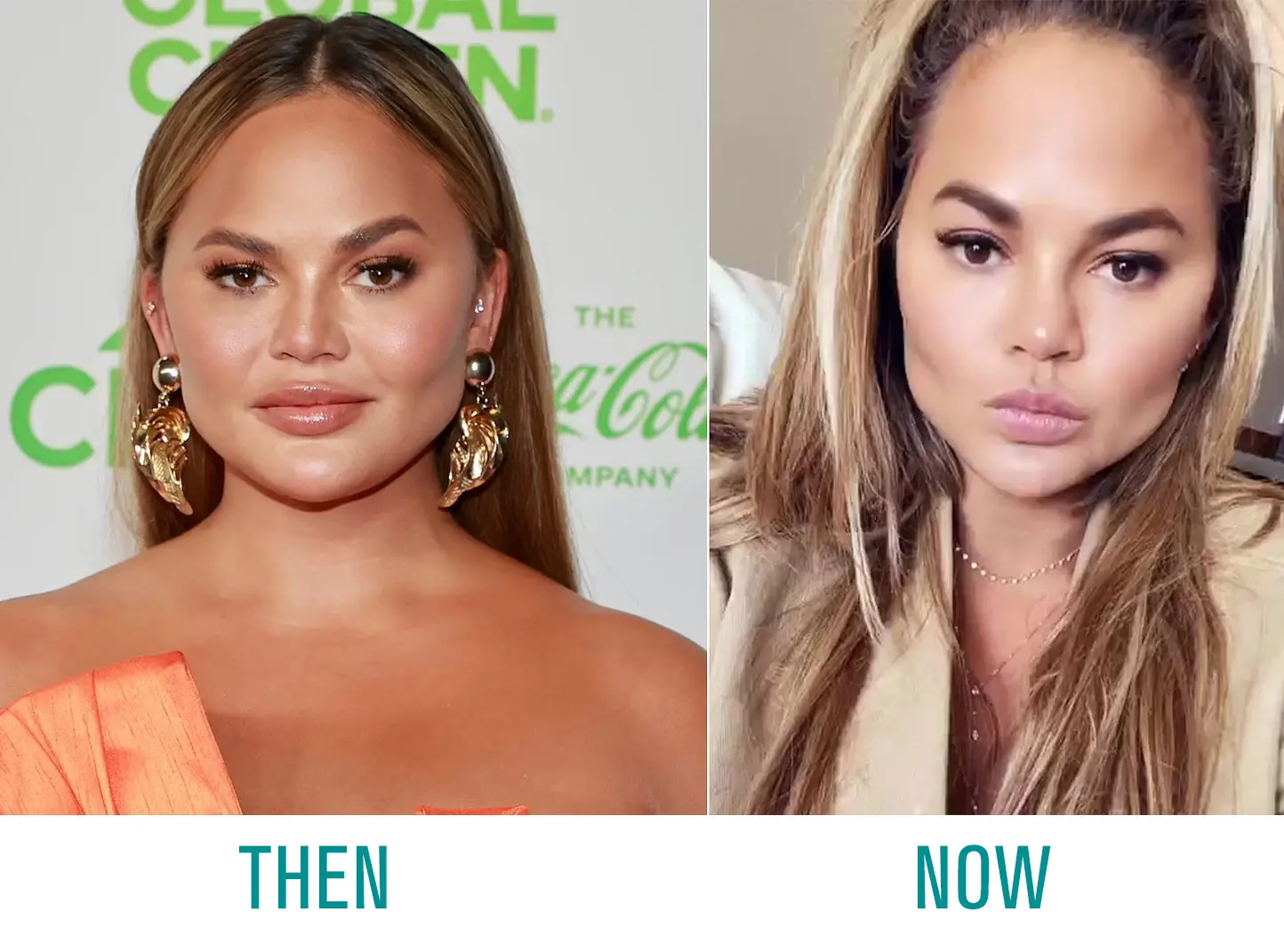 Chrissy Teigen Buccal Fat Removal