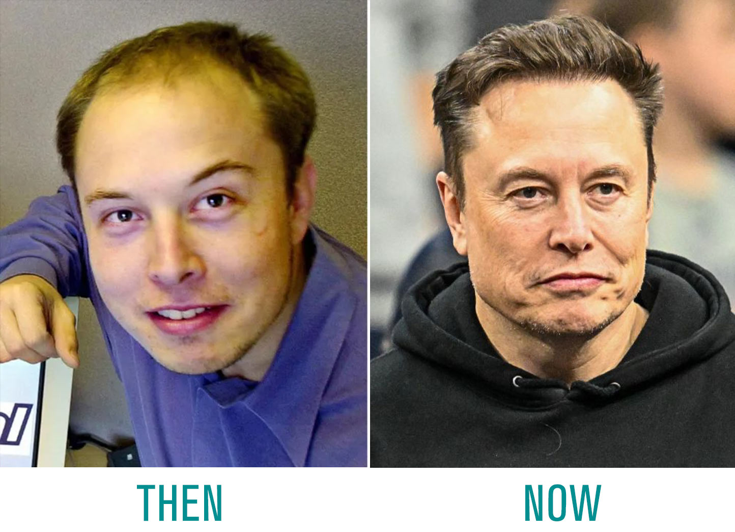 Elon-Musk-Hair-Transplant Elon Musk Hair Transplant