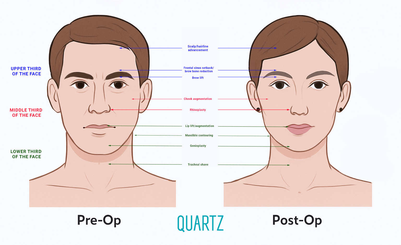 Facial FeminizationSurgery (FFS)