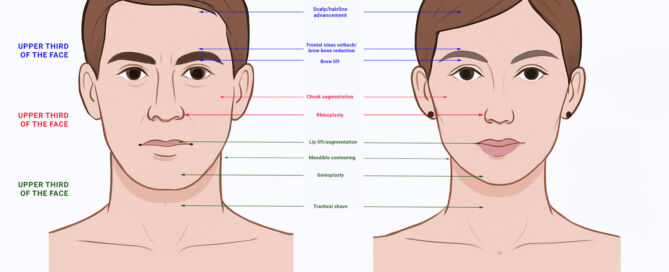 Facial Feminization Surgery FFS