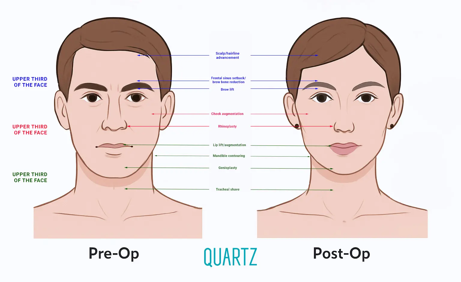 Facial Feminization Surgery FFS