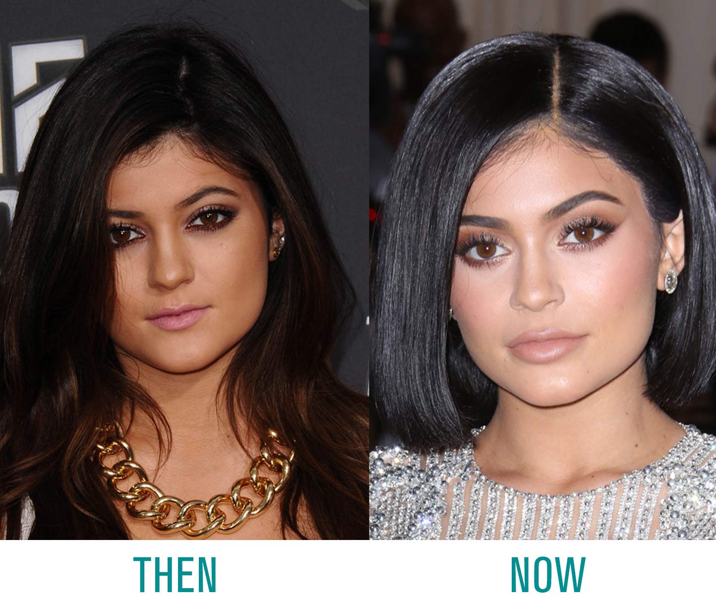 Kylie-Jenner-Lip-Fillers Kylie Jenner Lip Fillers