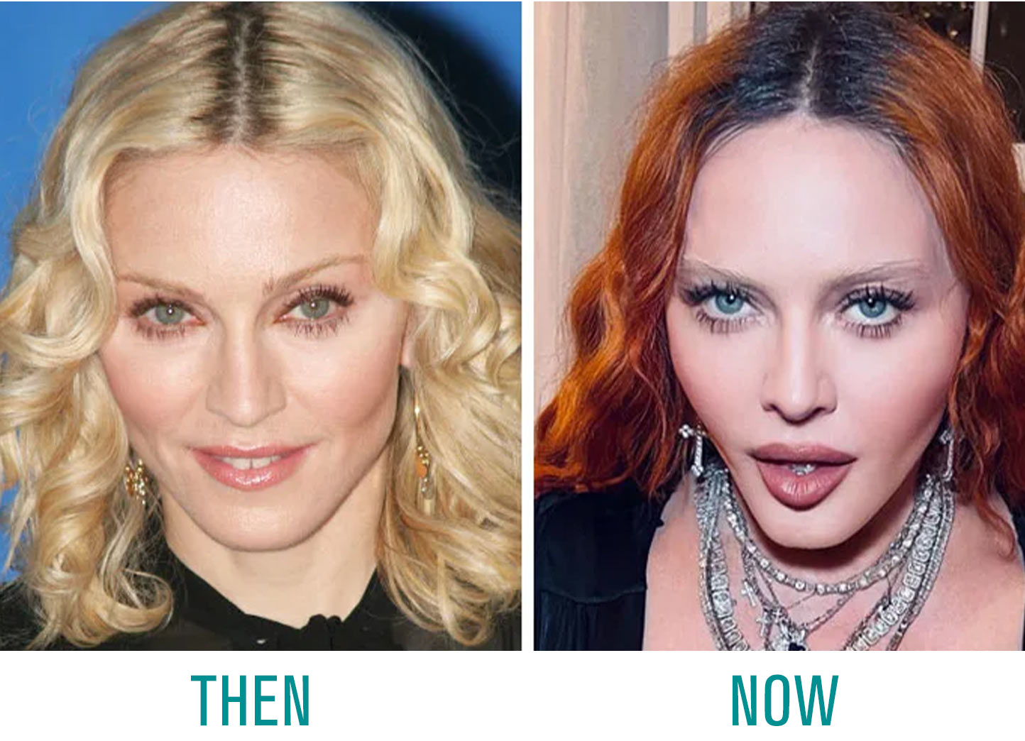 Madonna-Plastic-Surgery Madonna Plastic Surgery
