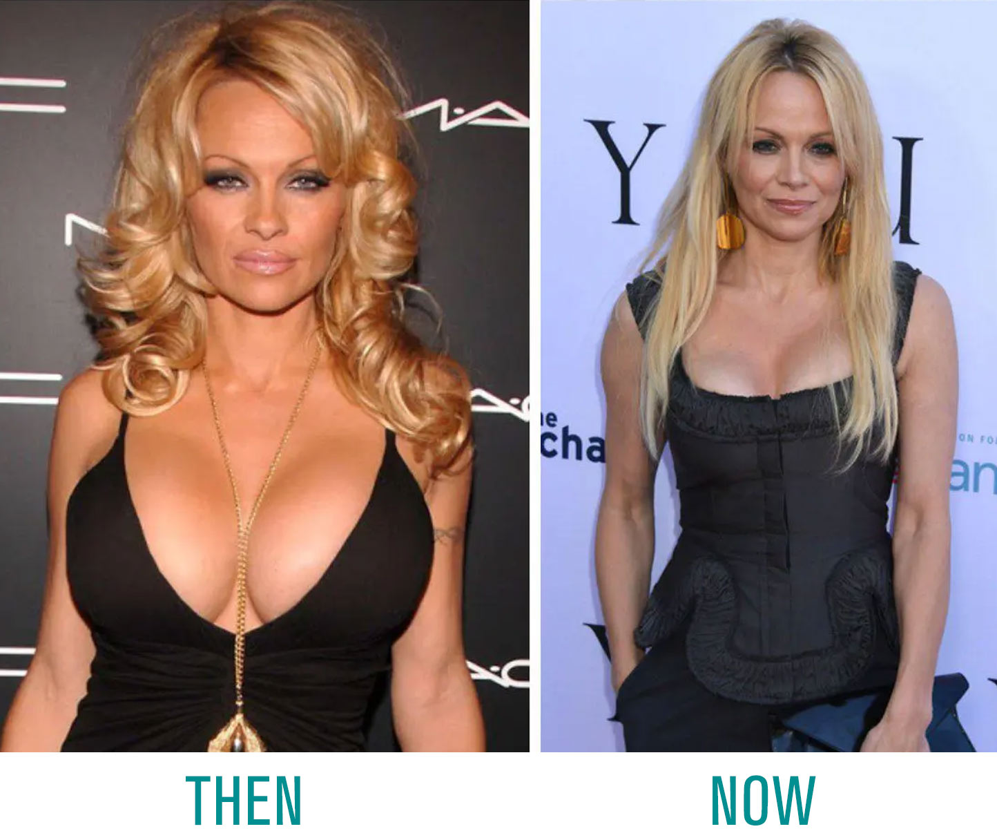 Pamela-Anderson-Breast-Implants Pamela Anderson Breast Implants