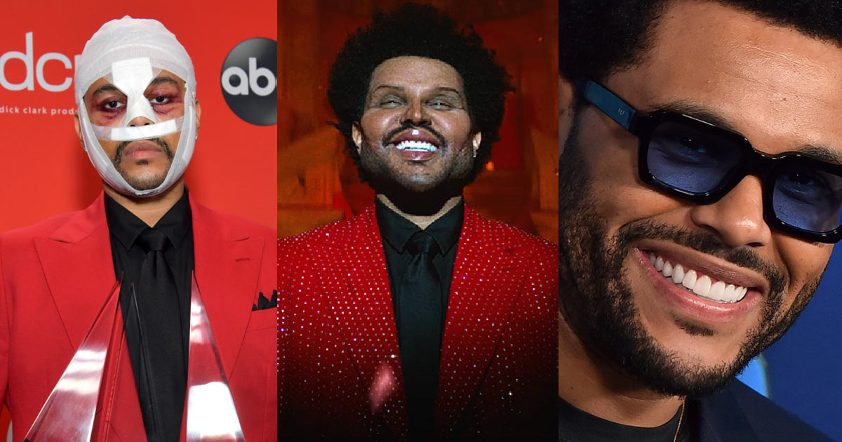 The-Weeknd-Plastic-Surgery The Weeknd Plastic Surgery