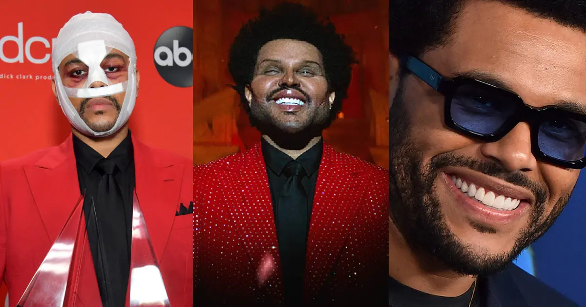 The Weeknd Plastic Surgery