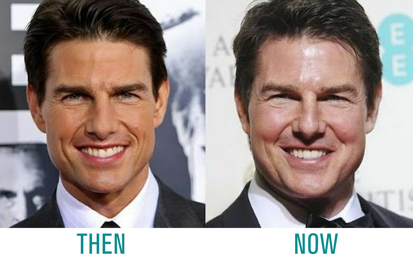 Tom Cruise Botox and Fillers Tom Cruise Botox and Fillers