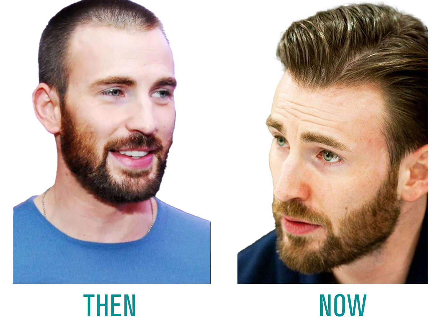 chris-evans-hair-transplantation chris evans hair transplantation