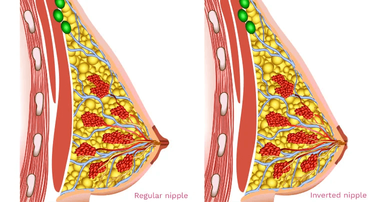 inverted nipple surgery