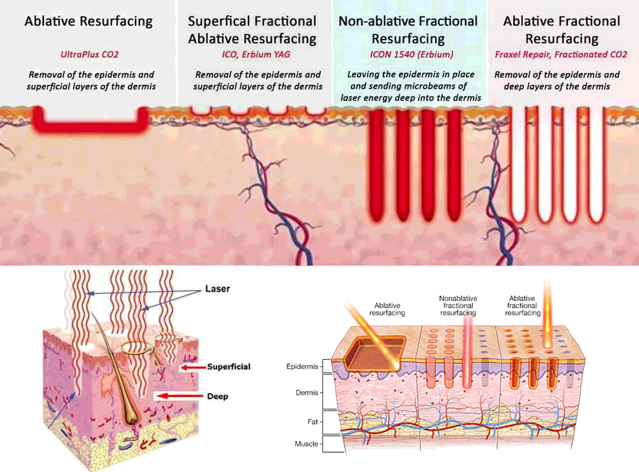 laser skin resurfacing