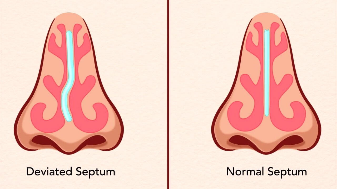 septum deviasyon