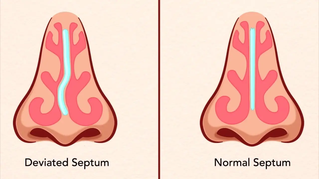 septum deviasyon