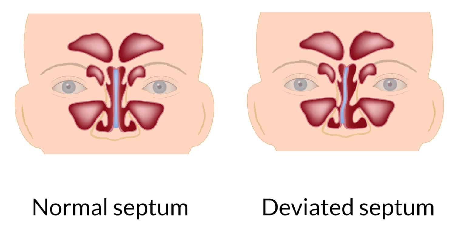 septum operasyonu