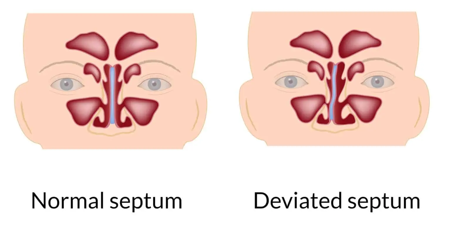 septum operasyonu